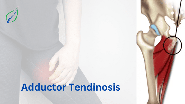 Adductor Tendinosis